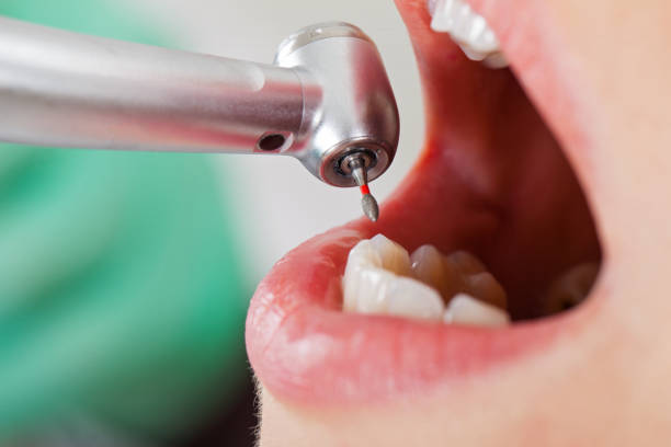 Best Emergency Tooth Extraction in Good Hope, AL